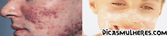 Saiba como se prevenir das malditas acnes