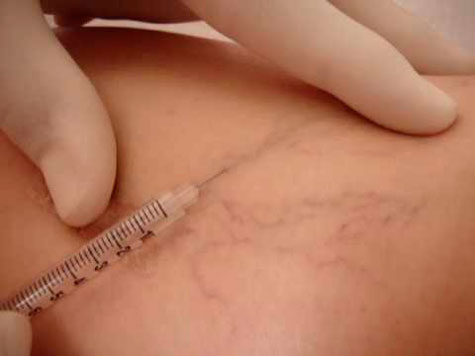 TRATAMENTOS PARA VASINHOS